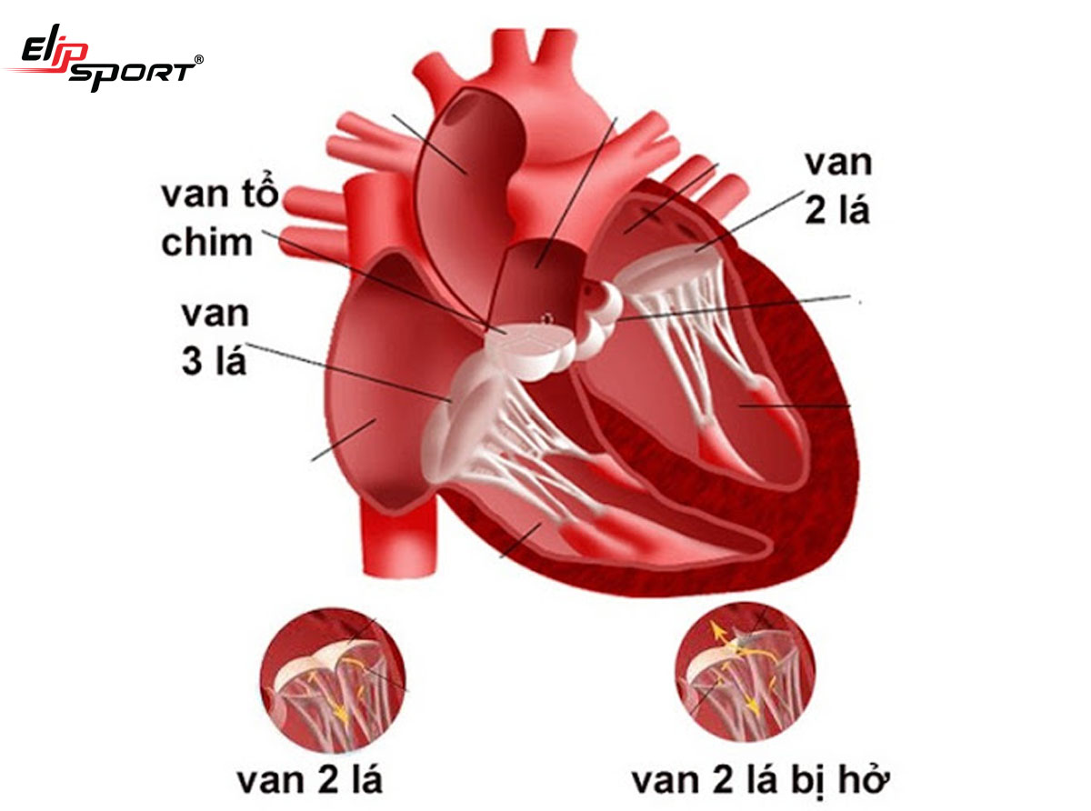 Bệnh hở van tim 2 lá là gì? Hở van tim 2 lá có nguy hiểm không?