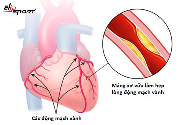 Cách chữa trị đau tim tại nhà hiệu quả nhanh