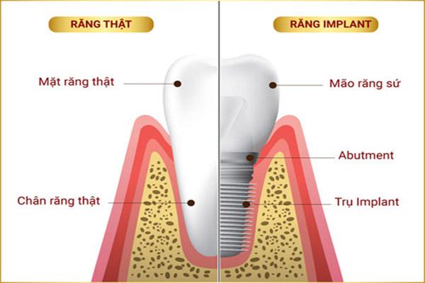 Giải Đáp Thắc Mắc Về Trồng Răng Implant