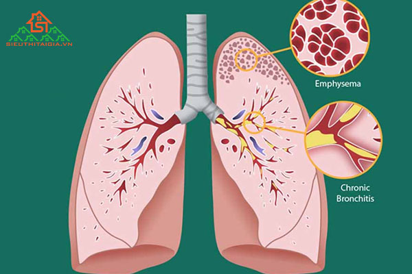 COPD là gì