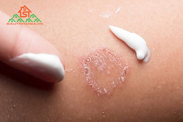 thuốc trị hắc lào
