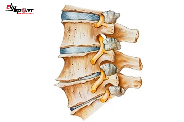  Cách Chữa Vôi Hóa Cột Sống Lưng Cột Sống