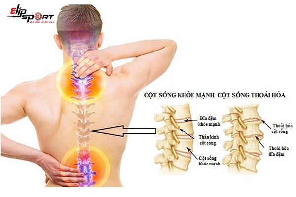 bệnh thoái hóa cột sống