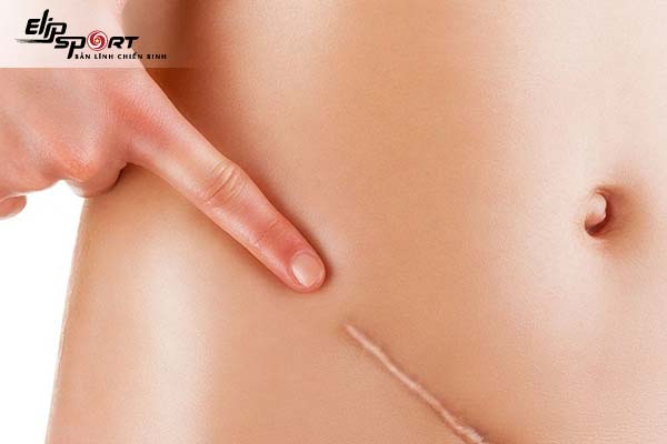 mổ ruột thừa có nên đi lại nhiều