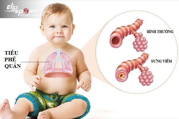 trẻ bị viêm tiểu phế quản