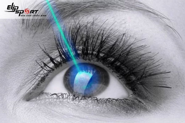 đeo lens cận có mổ mắt được không