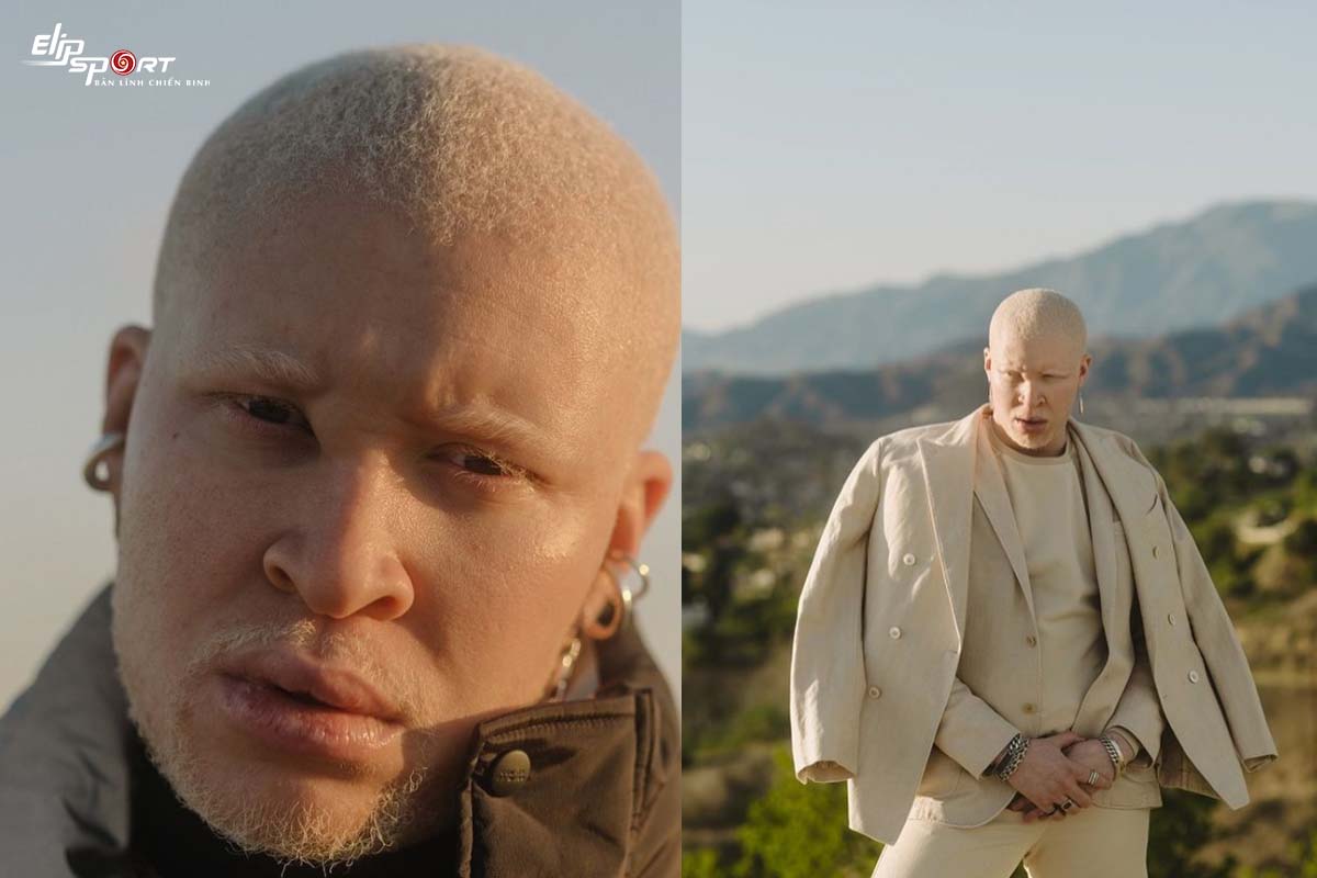 Người mẫu diễn viên, ca sĩ bạch tạng Shaun Ross 