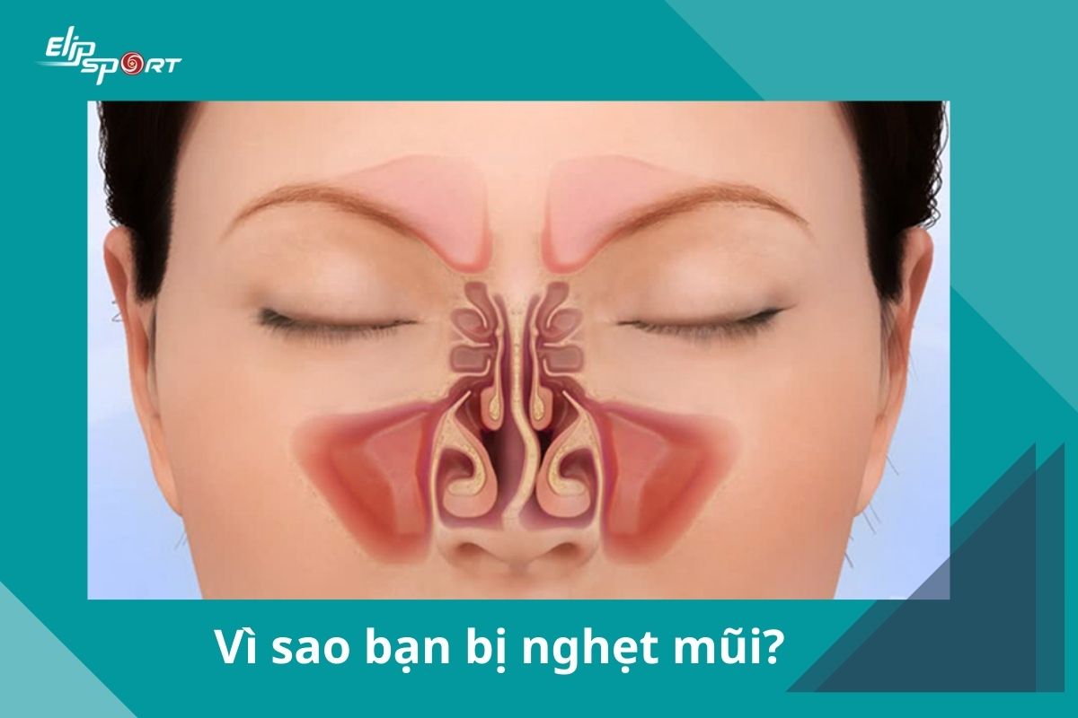 cách trị nghẹt mũi