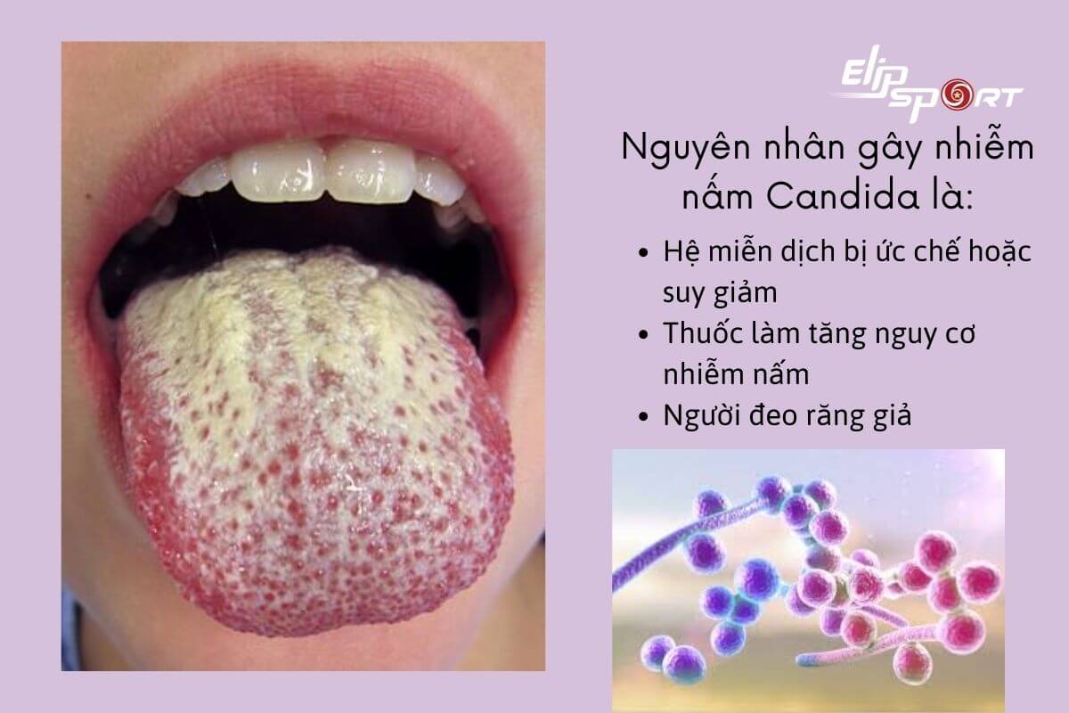 nấm Candida miệng
