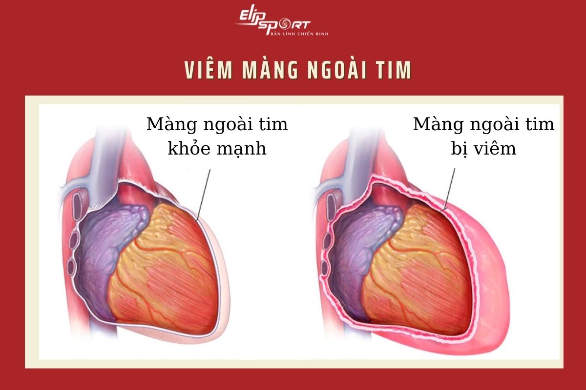 Viêm màng ngoài tim gây hít thở sâu bị nhói tim