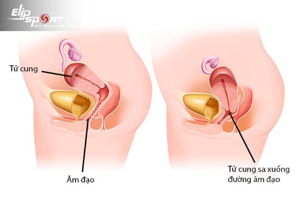 bài tập kegel cho phụ nữ sa tử cung