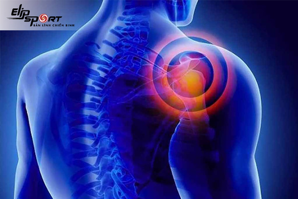 Rotator cuff là gì? Khắc phục hội chứng rotator cuff như thế nào?