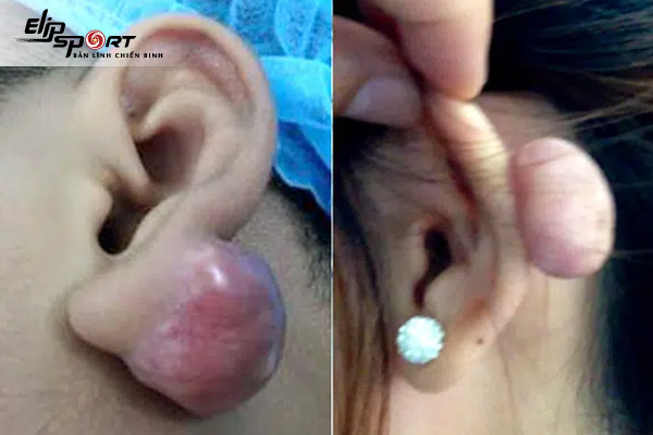Bấm lỗ tai bị sưng phải làm sao?