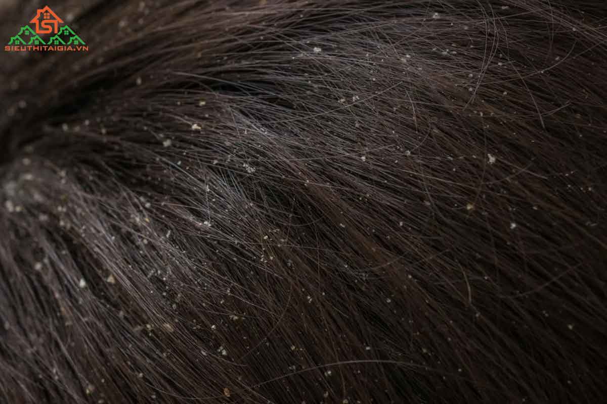 cách trị gàu bằng muối