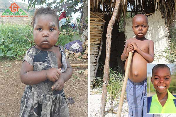 bệnh Kwashiorkor