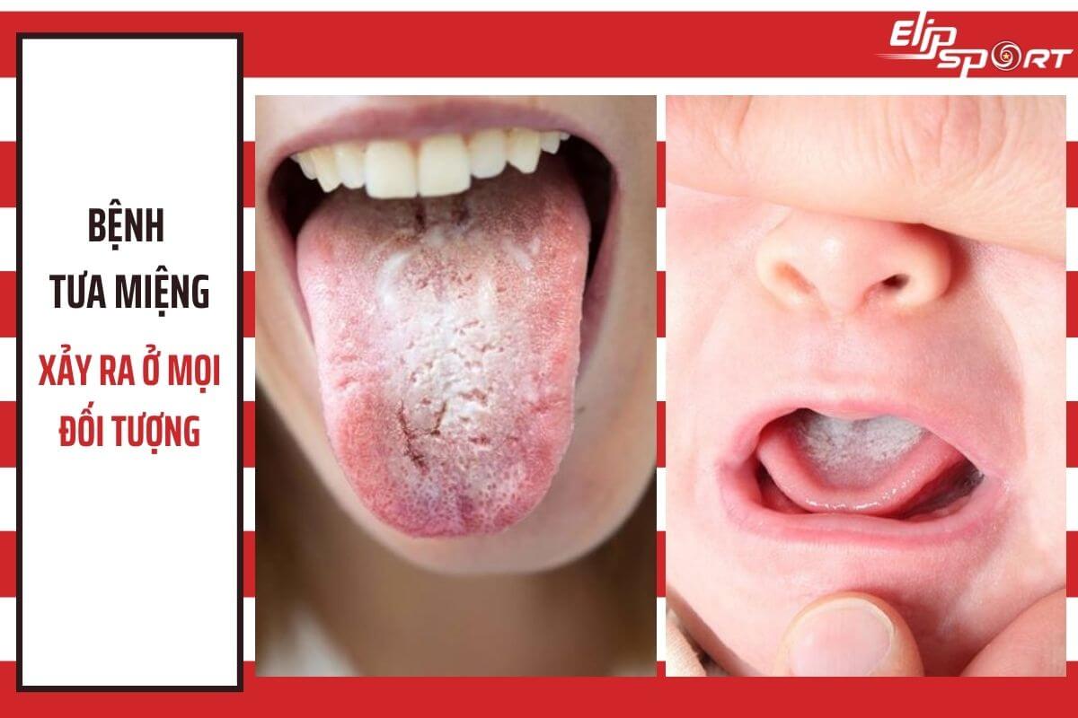 bệnh tưa miệng ở người lớn và trẻ nhỏ