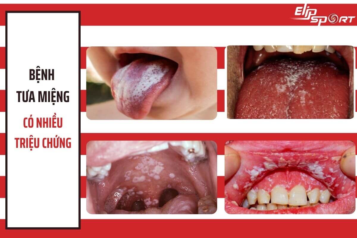 bệnh tưa miệng và triệu chứng