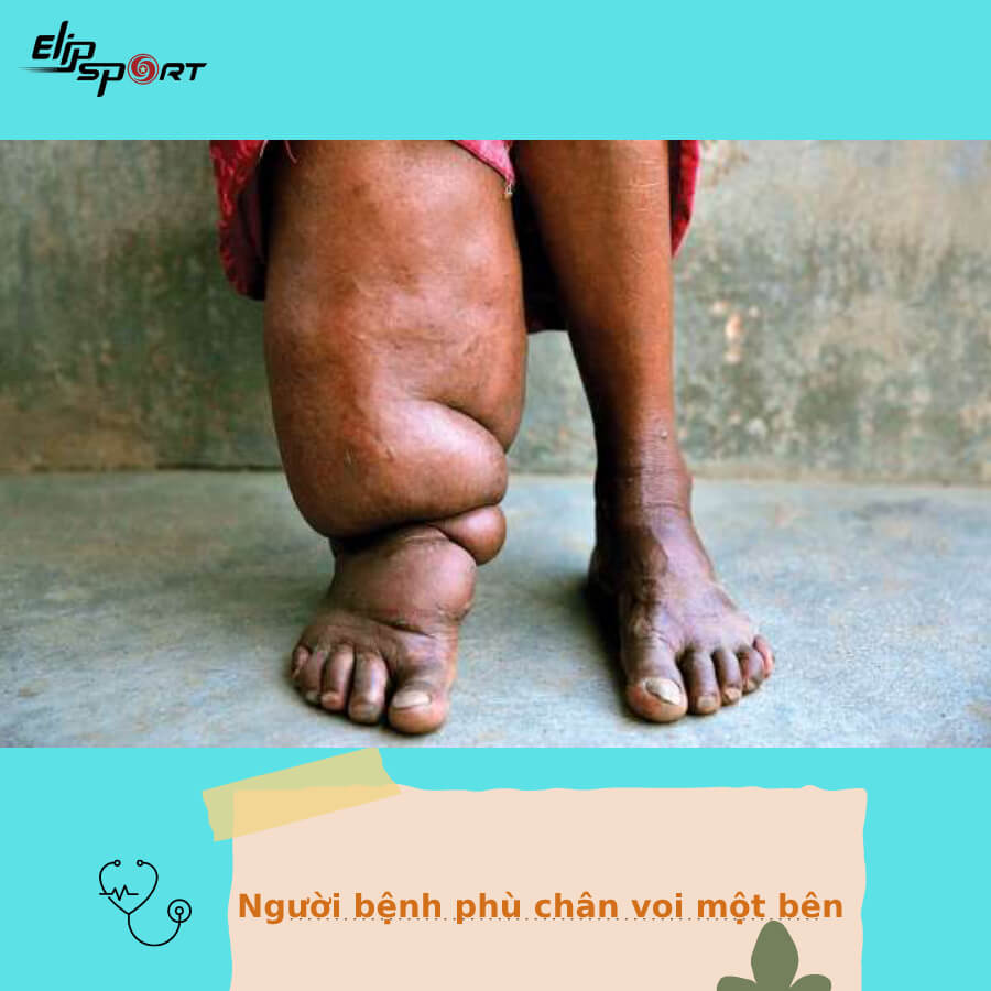 bệnh phù chân voi