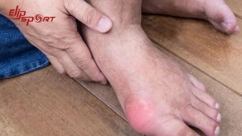 Người bị bệnh gout