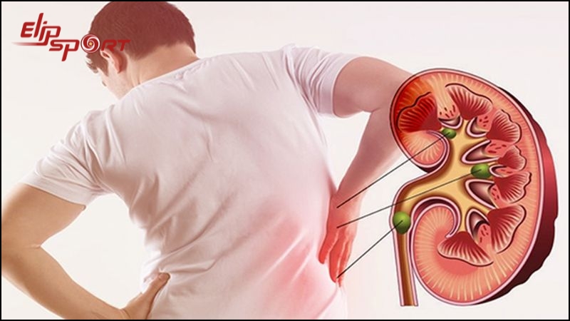 Người bị sỏi thận
