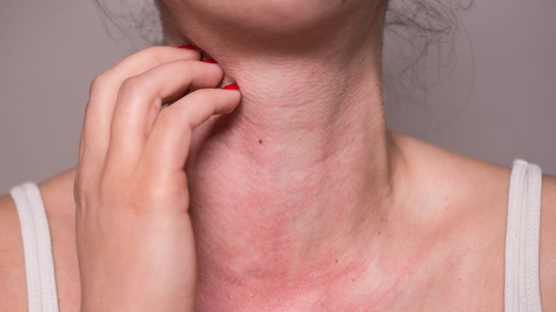 Nổi mẩn đỏ là một trong những triệu chứng khi dị ứng với đậu que