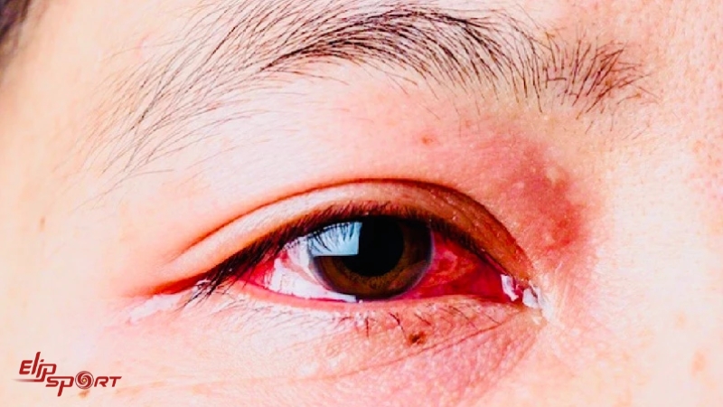 Không nên ăn tôm khi đang bị đau mắt đỏ