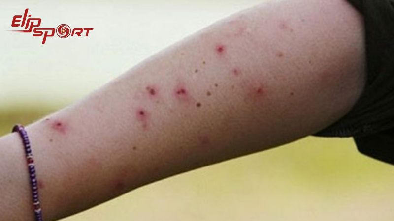 Nếu vết cắn của côn trùng chỉ để lại những nốt mụn đỏ thì bạn có thể điều trị tại nhà