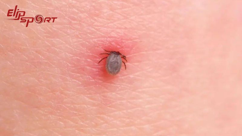 Phản ứng của cơ thể bạn đối với vết cắn của bọ ve là một đốm đỏ