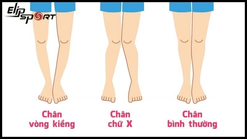 bé bị chân vòng kiềng