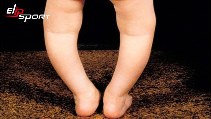 bé bị chân vòng kiềng
