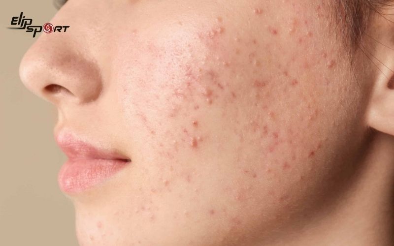Da của bạn thường trở nên nhờn và dễ xuất hiện mụn do sự tăng tiết dầu và sự phát triển của vi khuẩn P.acnes