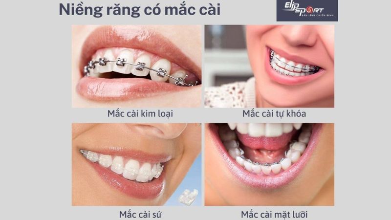 Dùng mắc cài là phương pháp niềng răng phổ biến nhất