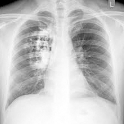 Nám phổi là hiện tượng gì?