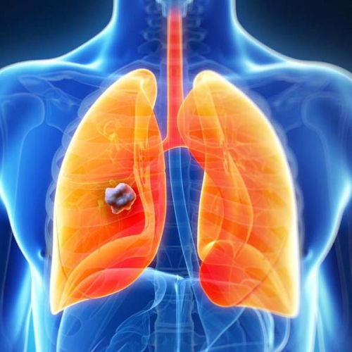 Triệu chứng u phổi là gì, điều trị thế nào?