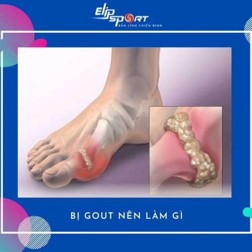 Người Bị Gout Nên Làm Gì, Có Nên Đi Bộ Không?