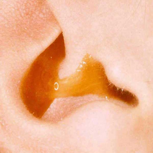 Đau tai chảy nước vàng có thể là triệu chứng của bệnh nào?