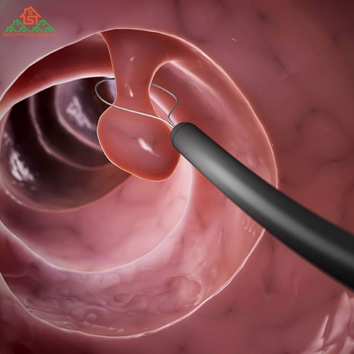 Bệnh Polyp Là Gì Và Biểu Hiện Như Thế Nào?