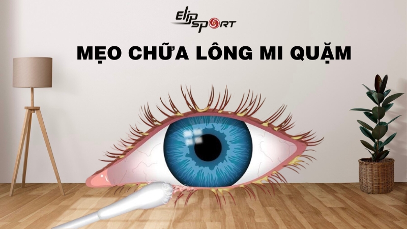 Lông mi mọc ngược, lông quặm là gì? Mẹo chữa lông quặm hiệu quả